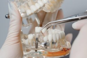 Model of a dental implant