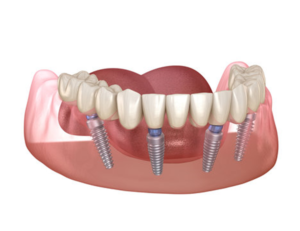 a close up of all-on-4 implants